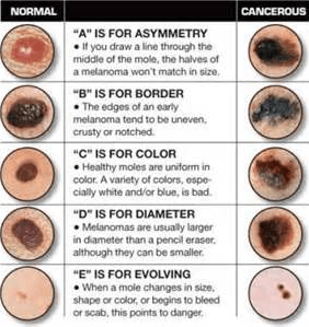 melanoma